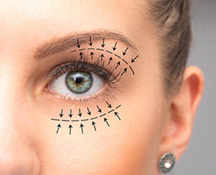 eyelid surgery blapharoplasty