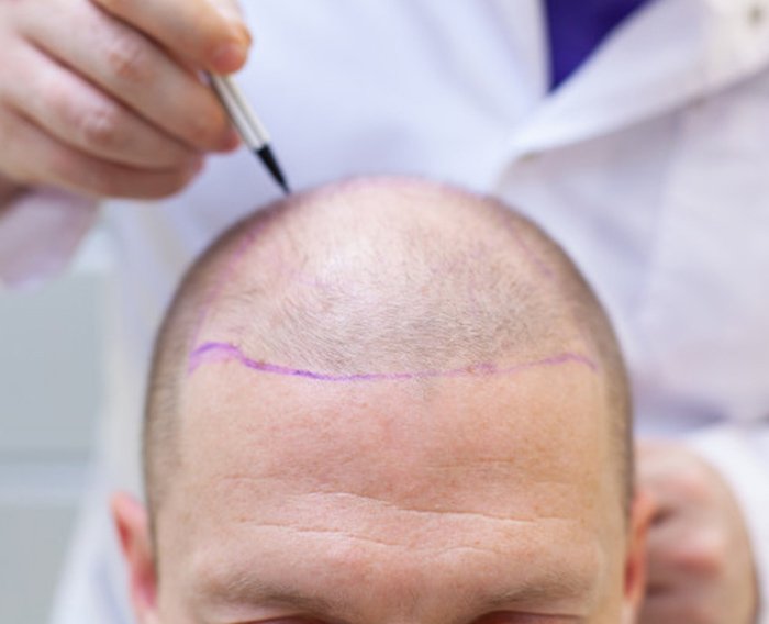 dhı hair transplant